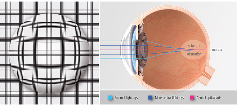 ImagePatientAspheric01EN.jpg