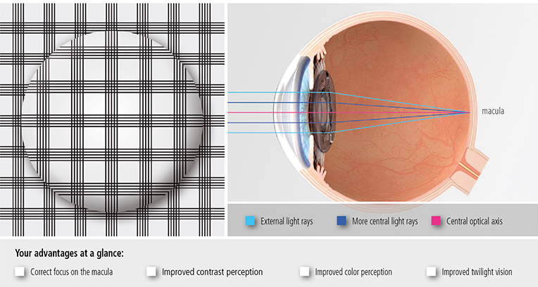 ImagePatientAspheric02ENend.jpg