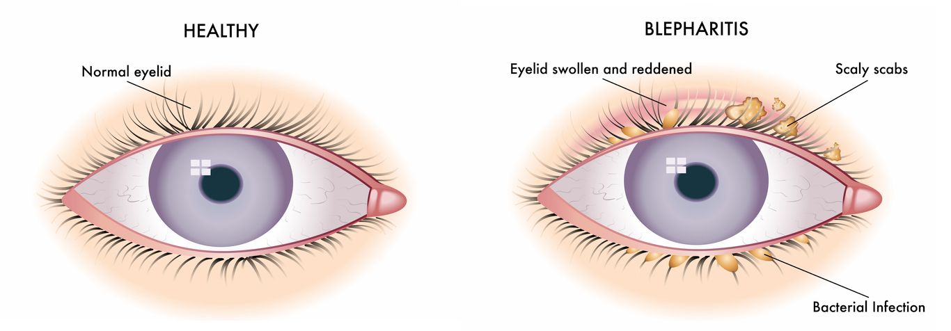 Healthy-blepharitis.jpg